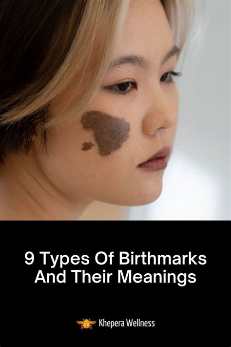 為什麼會有胎記|birthmark Q&A 寶寶的胎記會消失嗎？